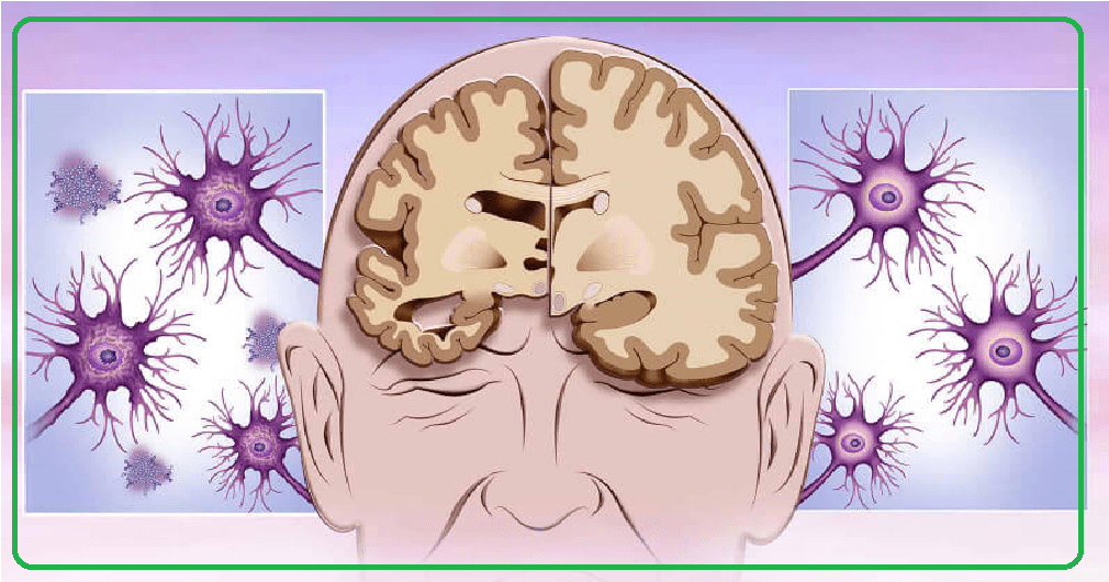 بیماری آلزایمر چگونه درمان می شود؟